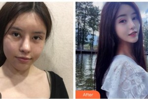 四川華美紫馨醫(yī)學美容醫(yī)院秦曉整形價格表附熱瑪吉案例展示