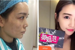 四川西嬋整形美容醫(yī)院曾占權整形價格表附激光祛斑案例展示