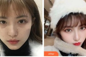四川西嬋泛亞醫(yī)學美容醫(yī)院馮中和整形價格表附熱瑪吉案例展示
