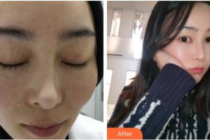 四川西嬋泛亞醫(yī)學美容醫(yī)院丁艷整形價格表附激光祛斑案例展示