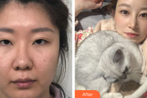 深圳臻瑞芝美醫(yī)療美容門診部林靖整形價格表附眼部修復案例展示
