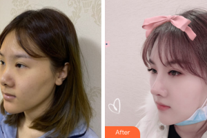 深圳微姿醫(yī)療美容門診部康壯為整形價格表附肋軟骨鼻部手術案例展示