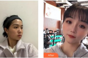 德陽(yáng)金榮醫(yī)療美容?？漆t(yī)院吳沙冰整形價(jià)格表附埋線提升案例展示
