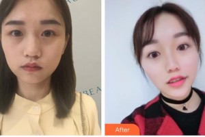 德陽(yáng)德美醫(yī)療美容門診部王俸祺整形價(jià)格表附熱瑪吉案例展示