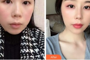 德陽金榮醫(yī)療美容?？漆t(yī)院邊森整形價(jià)格表附鼻部綜合案例展示