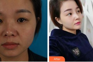 綿陽整形美容醫(yī)院趙波整形價(jià)格表附耳軟骨復(fù)合隆鼻案例展示
