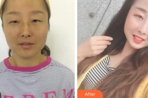 綿陽愛爾眼科醫(yī)院周晶蓉整形價格表附內切祛眼袋案例展示