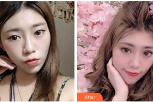廣元美華醫(yī)學美容診所楊林整形價格表附眼部綜合案例展示