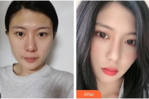 廣元美華醫(yī)學美容診所王見平整形價格表附眼部綜合案例展示