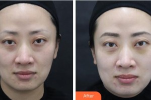 樂(lè)山王玉琨皮膚病?？漆t(yī)院王玉琨整形價(jià)格表附激光去眼袋案例展示