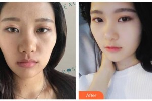 南充中心醫(yī)院整形美容外科雷英整形價格表附熱瑪吉案例展示