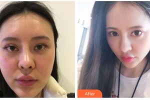 南充阿藍(lán)醫(yī)療美容門診部傅崇華整形價格表附埋線提升案例展示