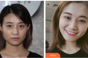 南充阿藍(lán)醫(yī)療美容門診部雷曉東整形價格表附埋線提升案例展示