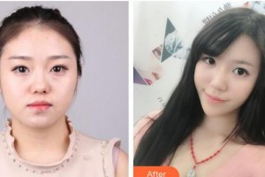 南充韓美整形美容門(mén)診部龔承安整形價(jià)格表附埋線(xiàn)提升案例展示