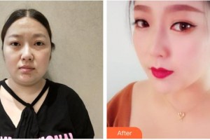 南充新韻悅美醫(yī)療美容門(mén)診部何秀整形價(jià)格表附埋線(xiàn)提升案例展示