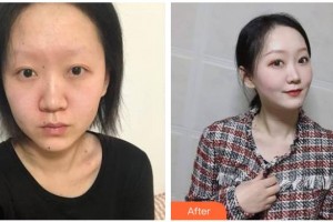 南充五星美容整形門(mén)診部劉隆澤整形價(jià)格表附埋線(xiàn)提升案列展示