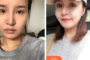 南充五星美容整形門(mén)診部劉漢儒整形價(jià)格表附埋線(xiàn)提升案例展示