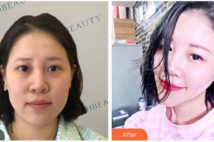 南充嬌美傾城醫(yī)學(xué)美容門診部曾飛整形價格表附熱瑪吉案例展示