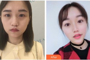 南充阿藍(lán)醫(yī)療美容門診部整形價格表附熱瑪吉案例展示