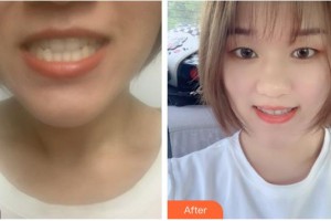 南充美佳口腔診所王永武整形價格表附牙齒隱形矯正案例展示