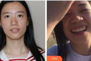 南充美佳口腔診所蘇懷風(fēng)整形價格表附牙齒隱形矯正案例展示