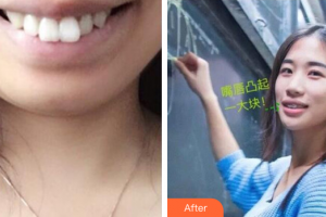深圳羅湖區(qū)同步口腔門診部戴秀秀整形價(jià)格表附金屬矯正案例展示