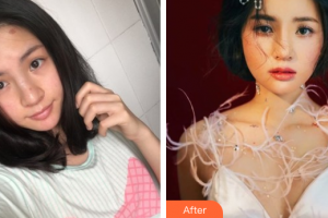 深圳纖韻醫(yī)療美容門診部鐘學(xué)行整形價(jià)格表附鼻部手術(shù)案例展示