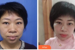眉山華信醫(yī)學(xué)整形美容醫(yī)院溫樹森整形價格表附激光去眼袋案例展示