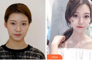 眉山華信醫(yī)學(xué)整形美容醫(yī)院李東泰整形價格表附切開雙眼皮案例展示