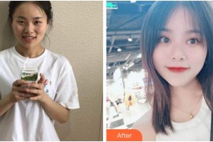 眉山華信醫(yī)學(xué)整形美容醫(yī)院金碩正整形價格表附開內(nèi)眼角案例展示