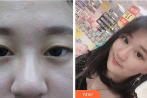 眉山市人民醫(yī)院醫(yī)學(xué)美容科張玉瓊整形價格表附定點雙眼皮案例展示