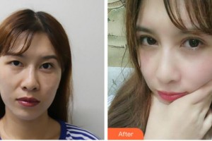 眉山眼耳鼻咽喉?？漆t(yī)院龔恩進整形價格表附切開雙眼皮案例展示