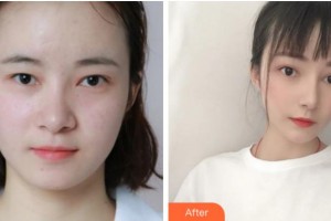 眉山市康復(fù)醫(yī)院眼科陳黎霞整形價格表附眼部綜合案例展示