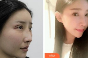 達(dá)州市中西醫(yī)結(jié)合醫(yī)院眼科鄒德整形價(jià)格表附切開雙眼皮案例展示