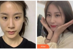 涼山愛(ài)爾眼科醫(yī)院肖玲整形價(jià)格表附切開雙眼皮案例展示