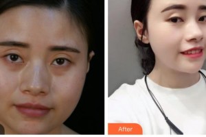 湖南省人民醫(yī)院整形激光美容中心歐陽華偉整形價(jià)格表附埋線提升案例展示