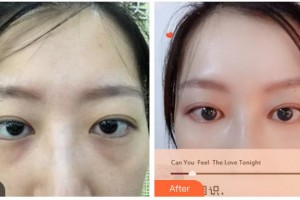 湖南省直中醫(yī)醫(yī)院眼科肖哲夫整形價格表附內(nèi)切祛眼袋案例展示