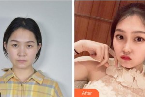 湖南韓美醫(yī)療美容門診部劉榮華整形價(jià)格表附眼部綜合案例展示