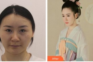 株洲中雅醫(yī)療美容門診部蔣松林整形價(jià)格表附埋線提升案例展示