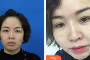 珠?；輴坩t(yī)院整形美容科陳曉華整形價(jià)格表附微針美膚案例展示