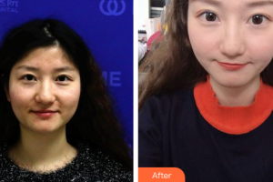 珠?；輴坩t(yī)院整形美容科董仲琴整形價(jià)格表附微針美膚案例展示