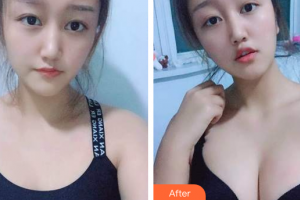 珠?？泼泪t(yī)療美容醫(yī)院張民望整形價(jià)格表附自體脂肪隆胸案例展示