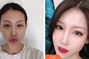珠?？泼泪t(yī)療美容醫(yī)院金俊浩整形價格表附眼部整形案例展示