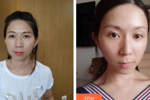 珠海陸達(dá)美容外科醫(yī)院周瑩整形價格表附埋線提升多方面部案例展示