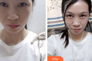 珠?；輴坩t(yī)院整形美容科羅艷紅整形價格表附眼部修復(fù)案例展示