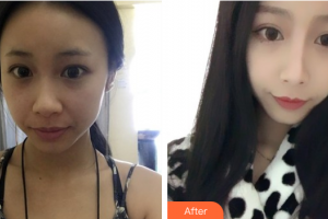 珠海艾瑞醫(yī)療美容醫(yī)院胡國華整形價格表附鼻部手術(shù)案例展示