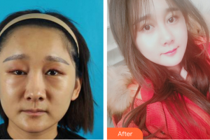 珠海吉大郭閆伏醫(yī)療美容診所張明興整形價格表附鼻部手術+埋線提升案例展示