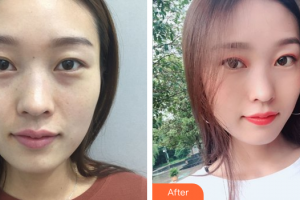 珠海韓妃醫(yī)療美容門診部項曉飛整形價格表附鼻部手術案例展示