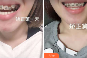 珠海拜博口腔醫(yī)院黎玲玲整形價(jià)格表附牙齒矯正案例展示