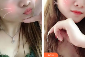 佛山亞韓整形美容門診部時安平整形價格表附紅藍(lán)光祛痘案例展示